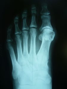 Артрозный hallus valgus