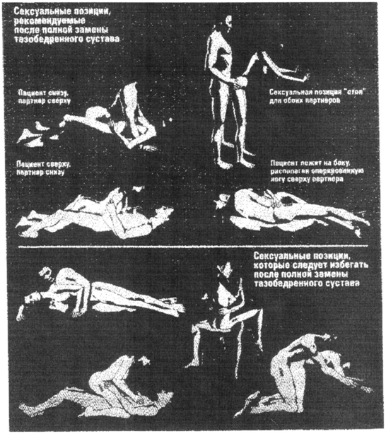 сексуальные позиции, рекомендуемые после полной замены тазобедренного сустава